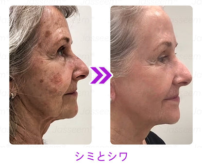 Bikenda® 高性能CO₂レーザーペン 🛫（痛みなし・面倒なしで、イボ・ほくろ・シミ・小さな肌のふくらみをやさしく除去！）お肌のケアにおすすめの非侵襲的アイテムだよ！