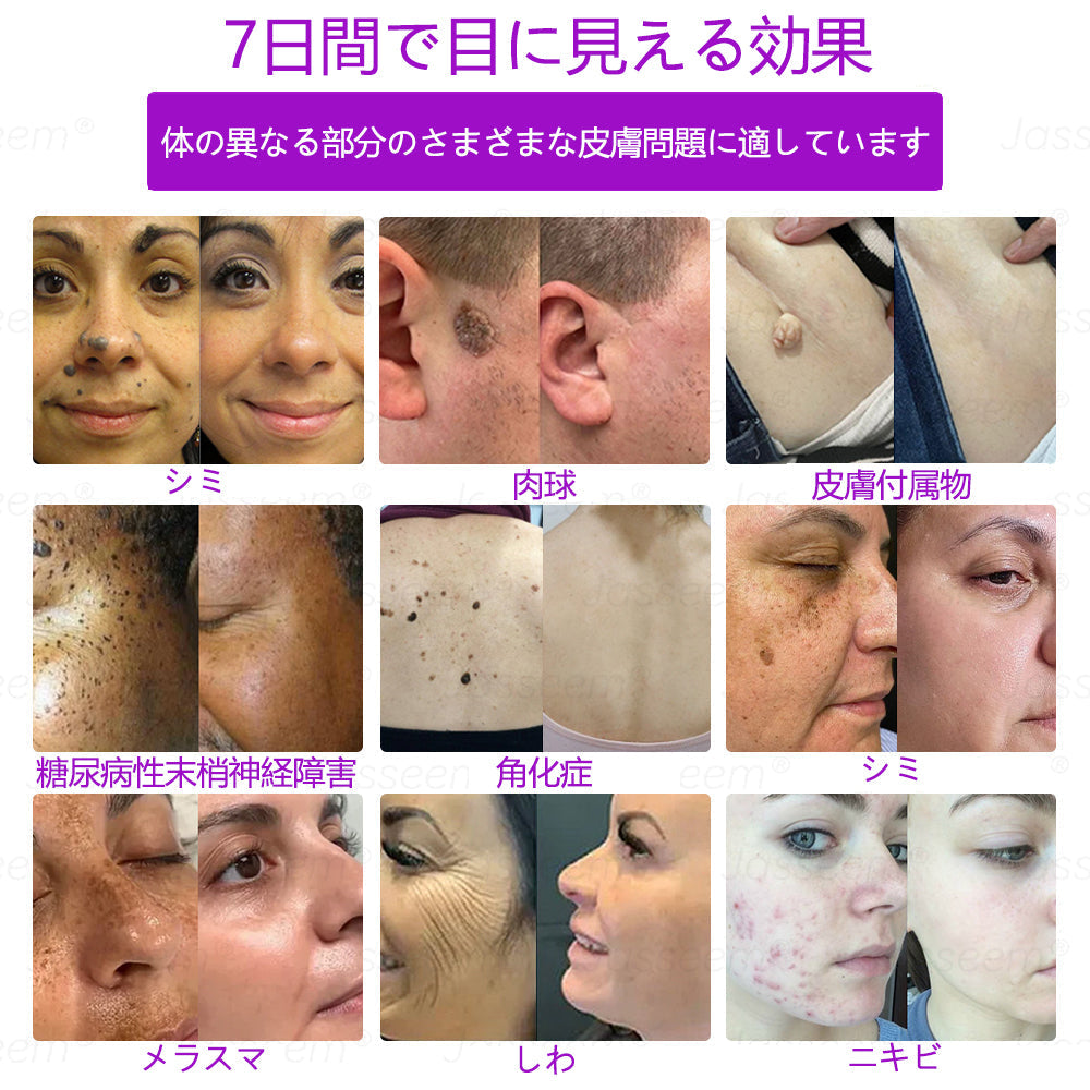 Bikenda® 高性能CO₂レーザーペン 🛫（痛みなし・面倒なしで、イボ・ほくろ・シミ・小さな肌のふくらみをやさしく除去！）お肌のケアにおすすめの非侵襲的アイテムだよ！