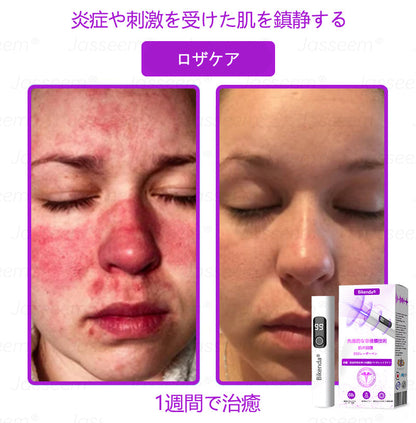 Bikenda® 高性能CO₂レーザーペン 🛫（痛みなし・面倒なしで、イボ・ほくろ・シミ・小さな肌のふくらみをやさしく除去！）お肌のケアにおすすめの非侵襲的アイテムだよ！