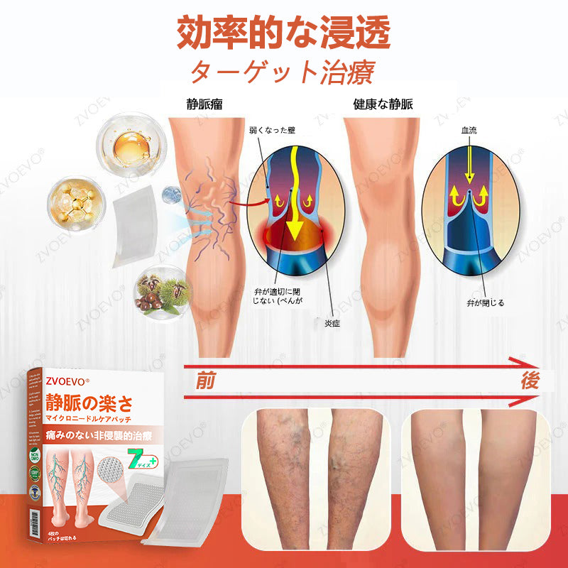 ☘️【厚生労働省認可・GMP準拠】Zvoevo® Vein Ease マイクロニードルケアパッチ（クモ状静脈・静脈瘤・むくみ・脚の疲れに）