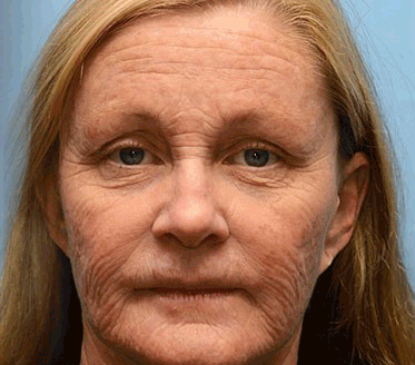 💎🐝 Furzero™ ボトックス＆ビーベノム しわ取りリフトアップクリーム✨🔥 最終日限定プロモーション – 70%OFF ✨🔥