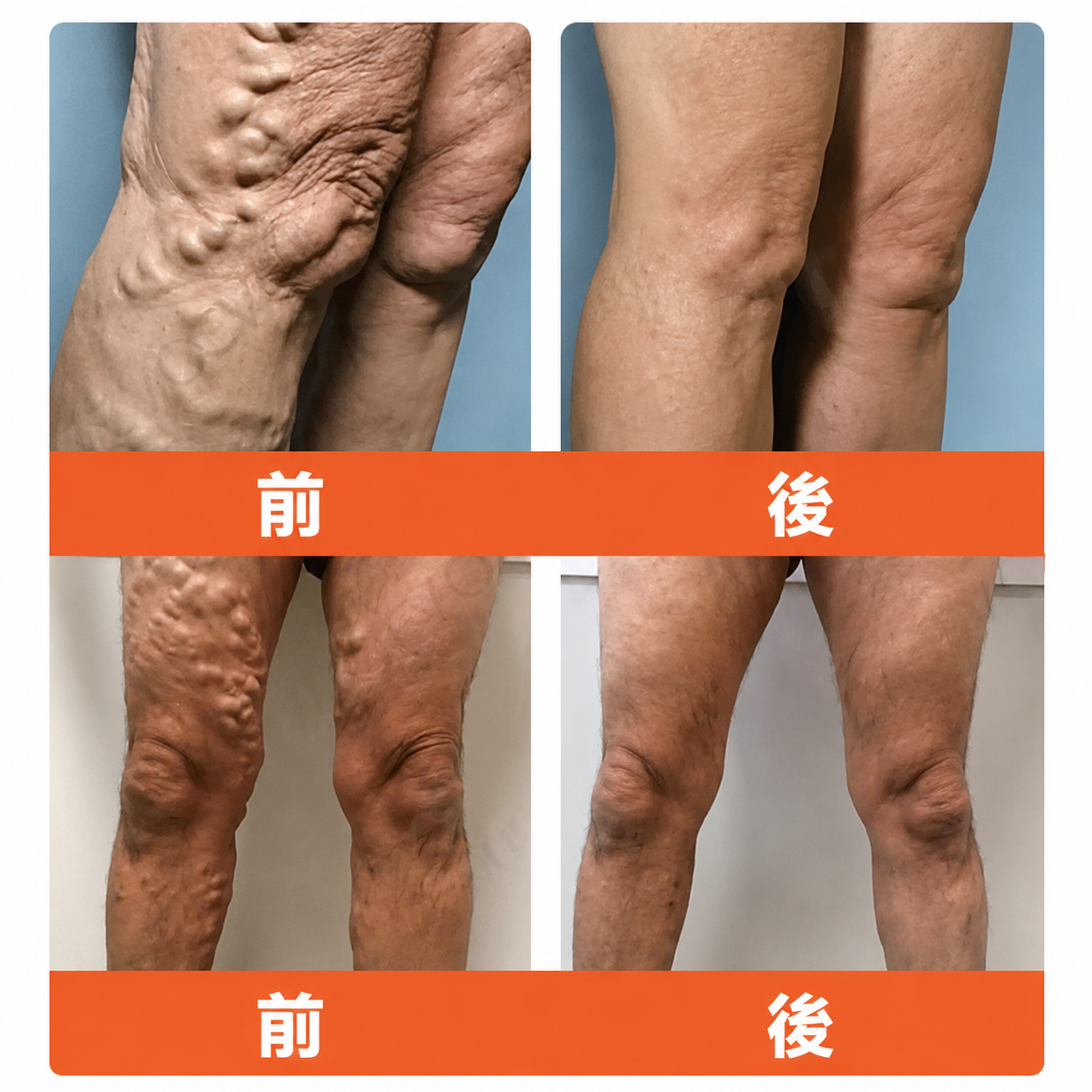 ☘️【厚生労働省認可・GMP準拠】Zvoevo® Vein Ease マイクロニードルケアパッチ（クモ状静脈・静脈瘤・むくみ・脚の疲れに）